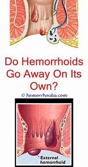 How To Cure External Hemorrhoids