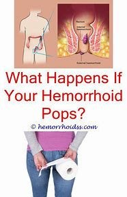 How To Cure Internal Hemorrhoids