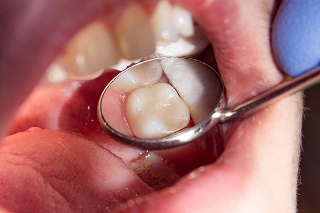 How To Treat Wisdom Tooth