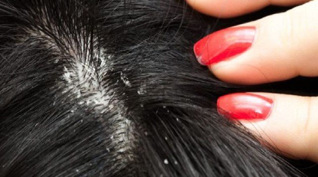 I Suffer From Dandruff Or Seborrhea, What Can I Do To Cure Myself