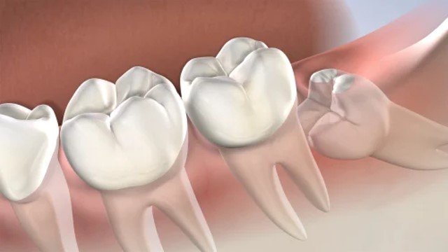 What Is The Wisdom Tooth In People