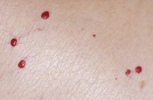 What To Do When Red Moles Appear On Your Skin