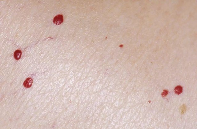 What To Do When Red Moles Appear on Your Skin