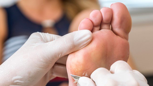 What To Do When You Have Calluses On Your Feet