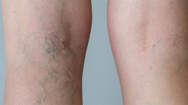 Why Are the Veins in The Legs Inflamed?