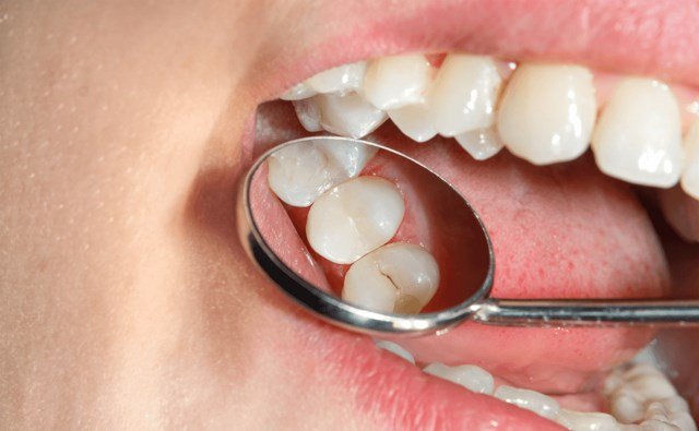 Why Do Sugary Snacks Cause Tooth Decay?
